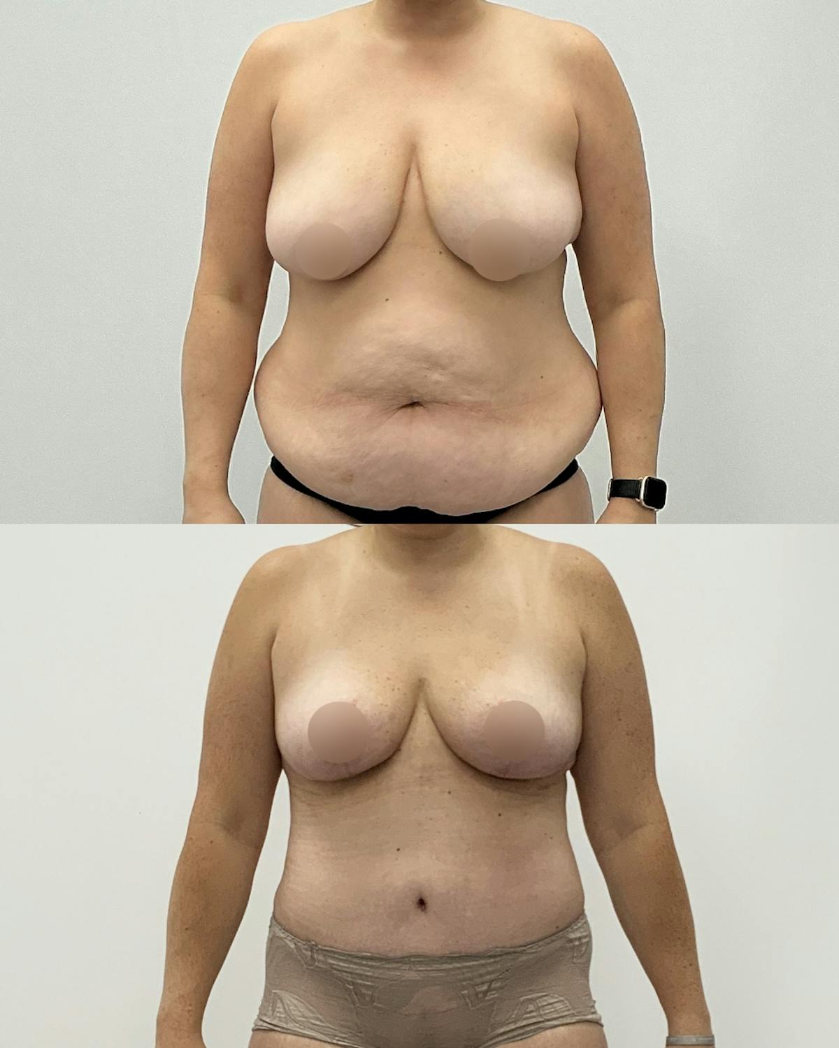 Mommy Makeover Before & After Gallery - Patient 263459 - Image 1