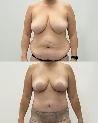 Mommy Makeover Before & After Gallery - Patient 263459 - Image 1