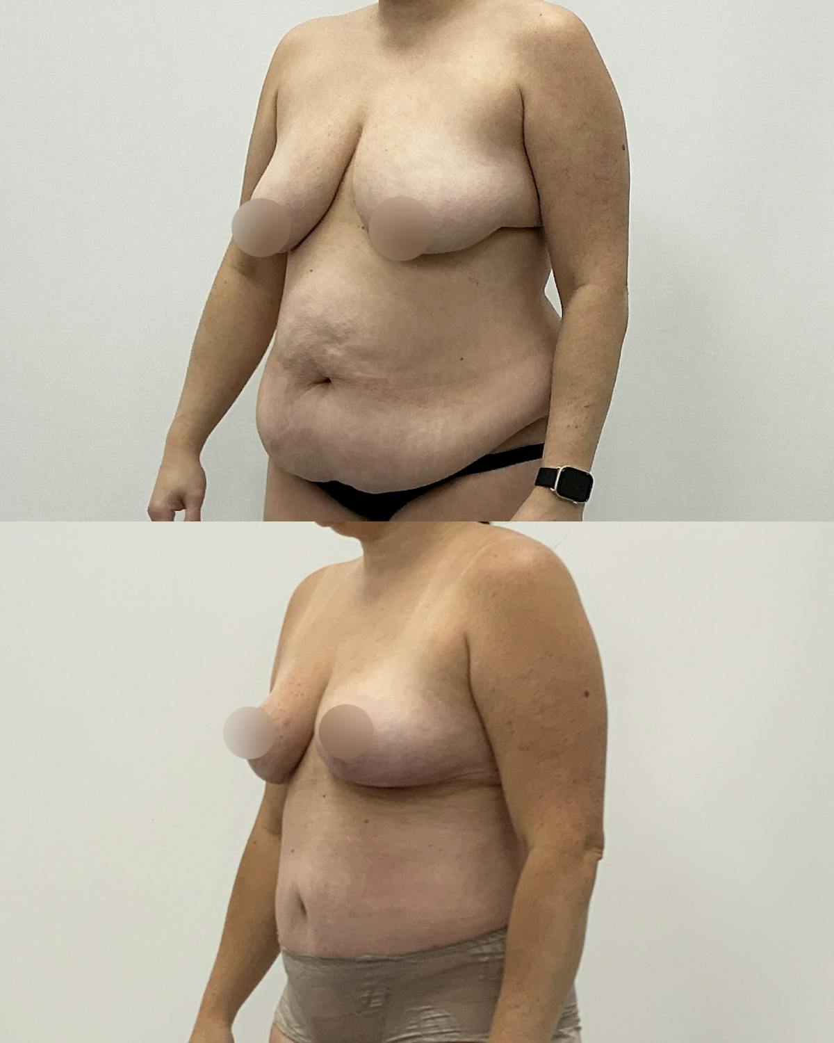 Mommy Makeover Before & After Gallery - Patient 263459 - Image 2