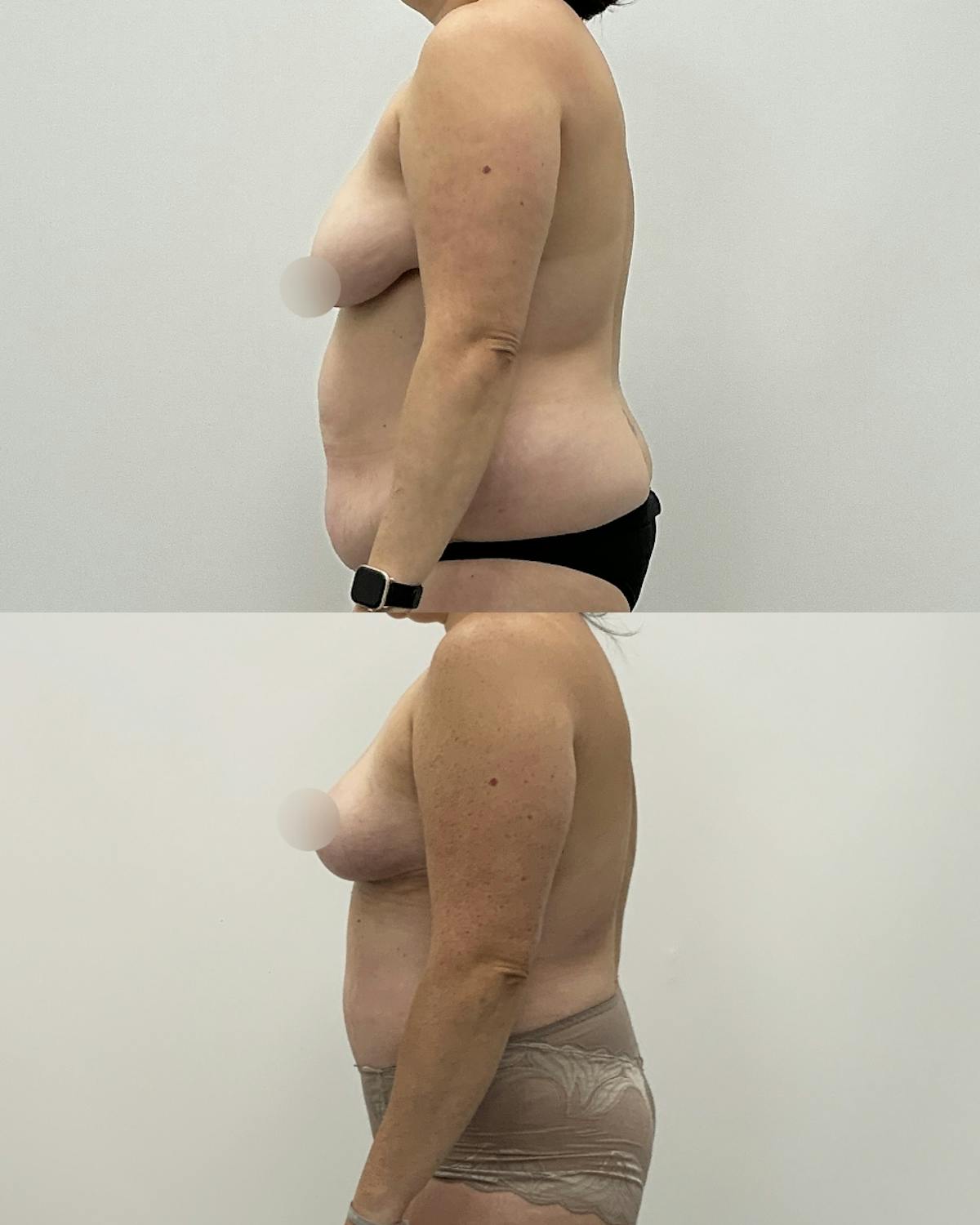 Mommy Makeover Before & After Gallery - Patient 263459 - Image 3