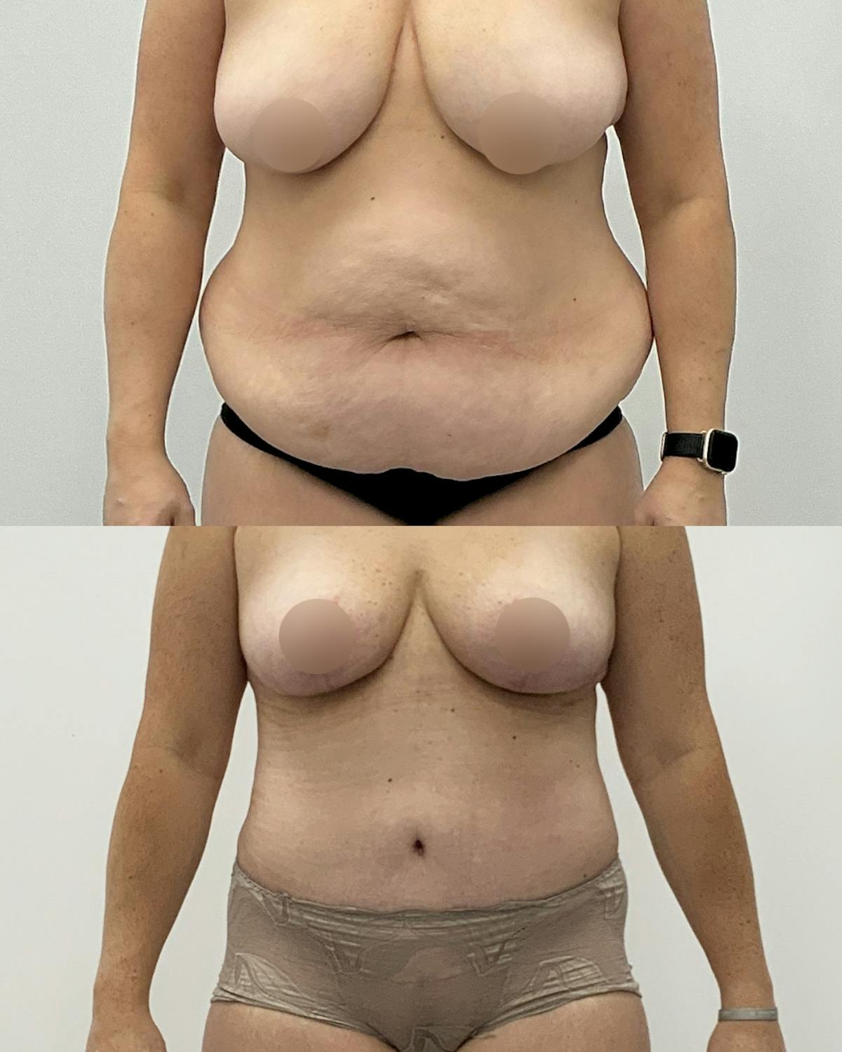 Tummy Tuck Before & After Gallery - Patient 294318 - Image 1