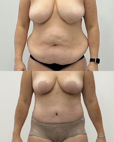Tummy Tuck Before & After Gallery - Patient 294318 - Image 1