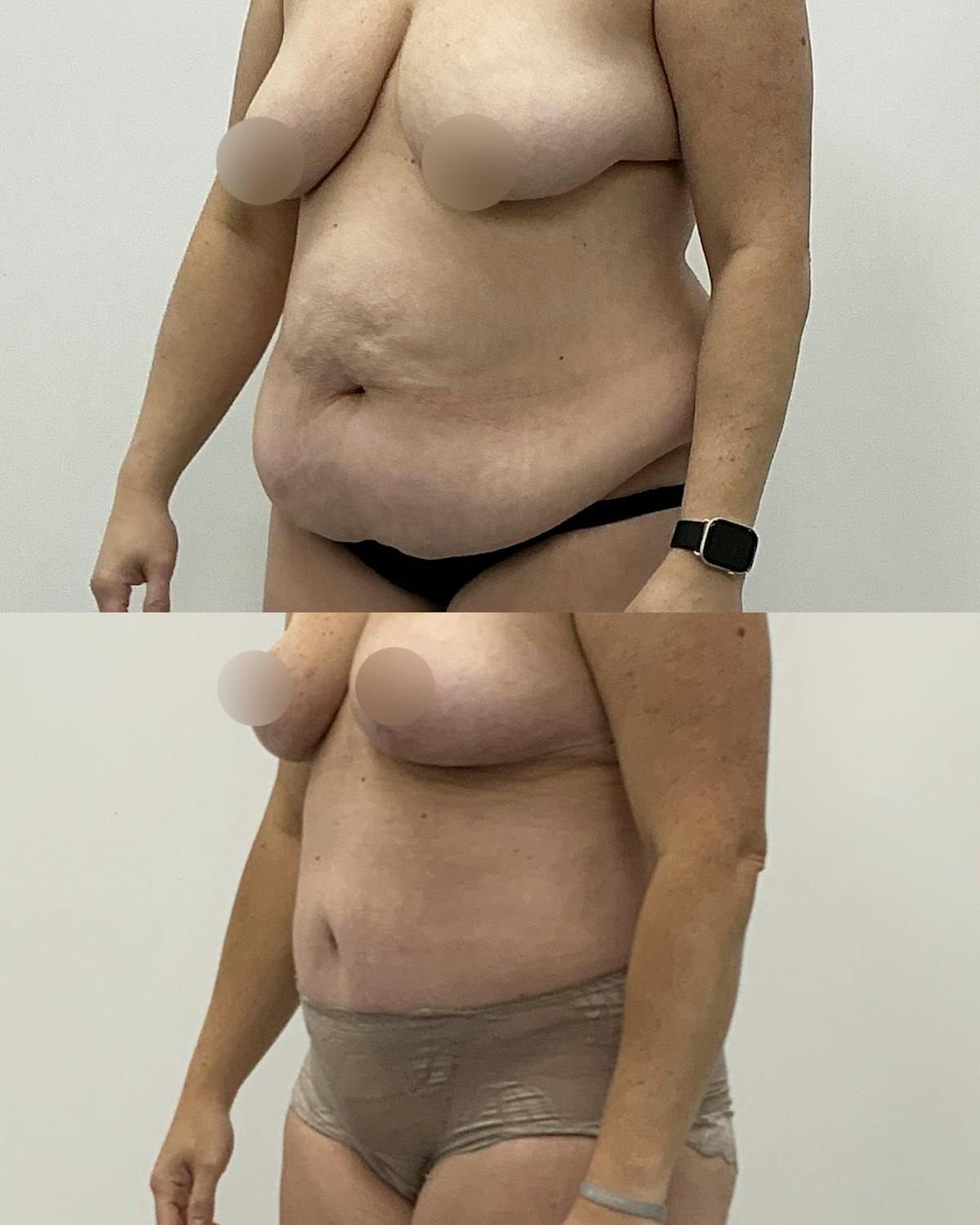 Tummy Tuck Before & After Gallery - Patient 294318 - Image 2