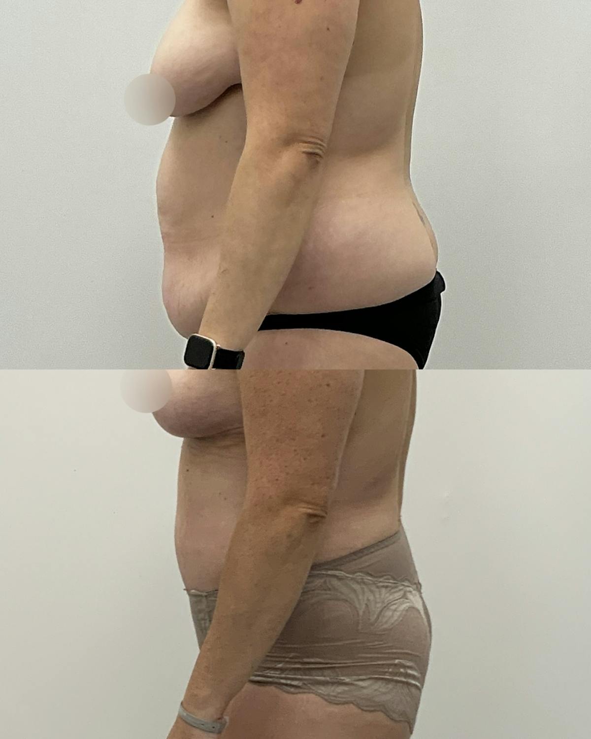Tummy Tuck Before & After Gallery - Patient 294318 - Image 3