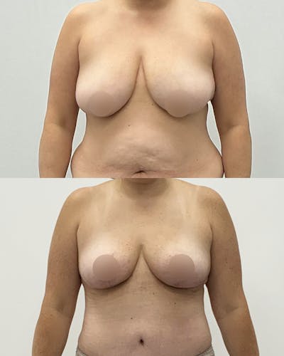Breast Lift Before & After Gallery - Patient 115477 - Image 1