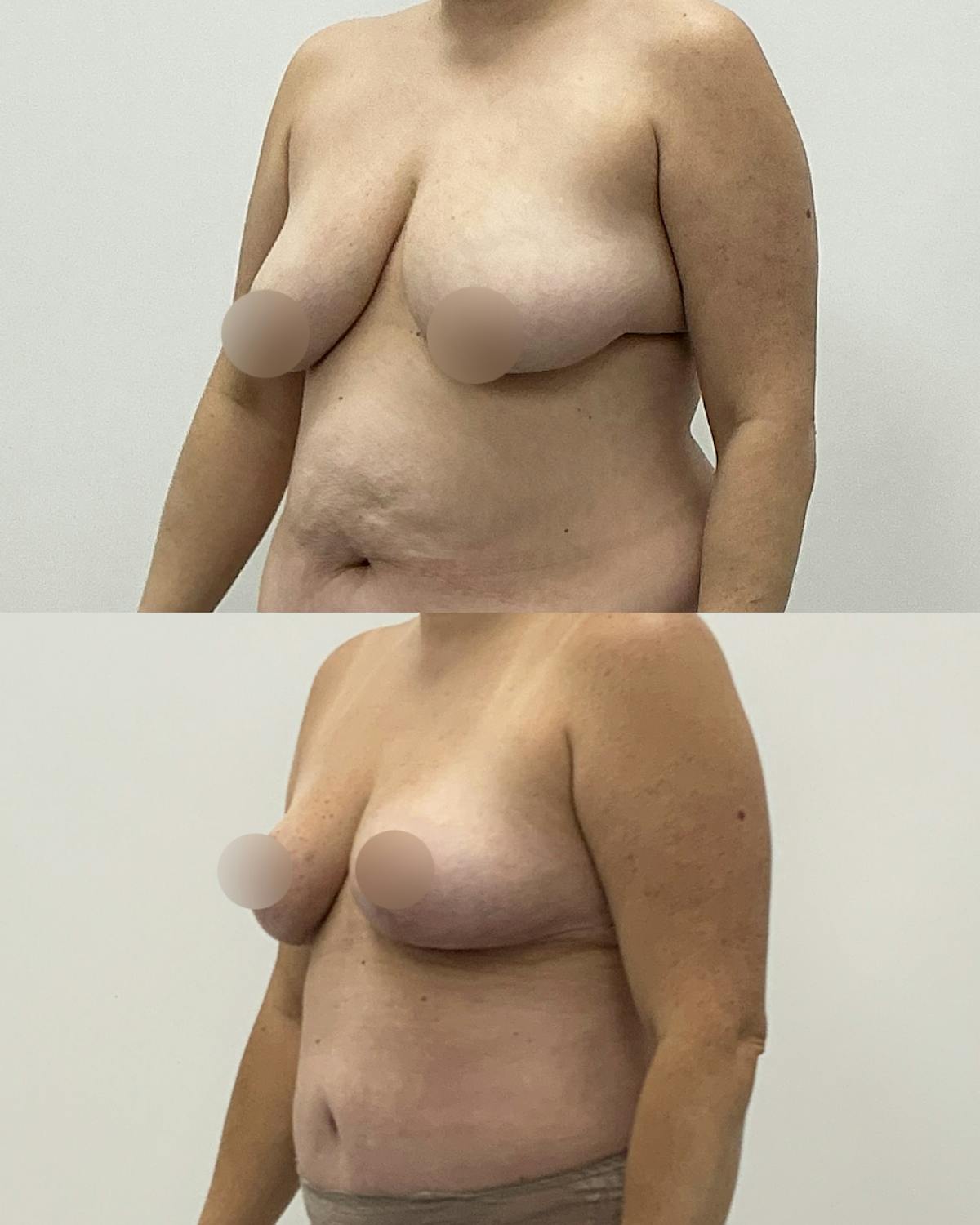Breast Reduction Before & After Gallery - Patient 110044 - Image 2