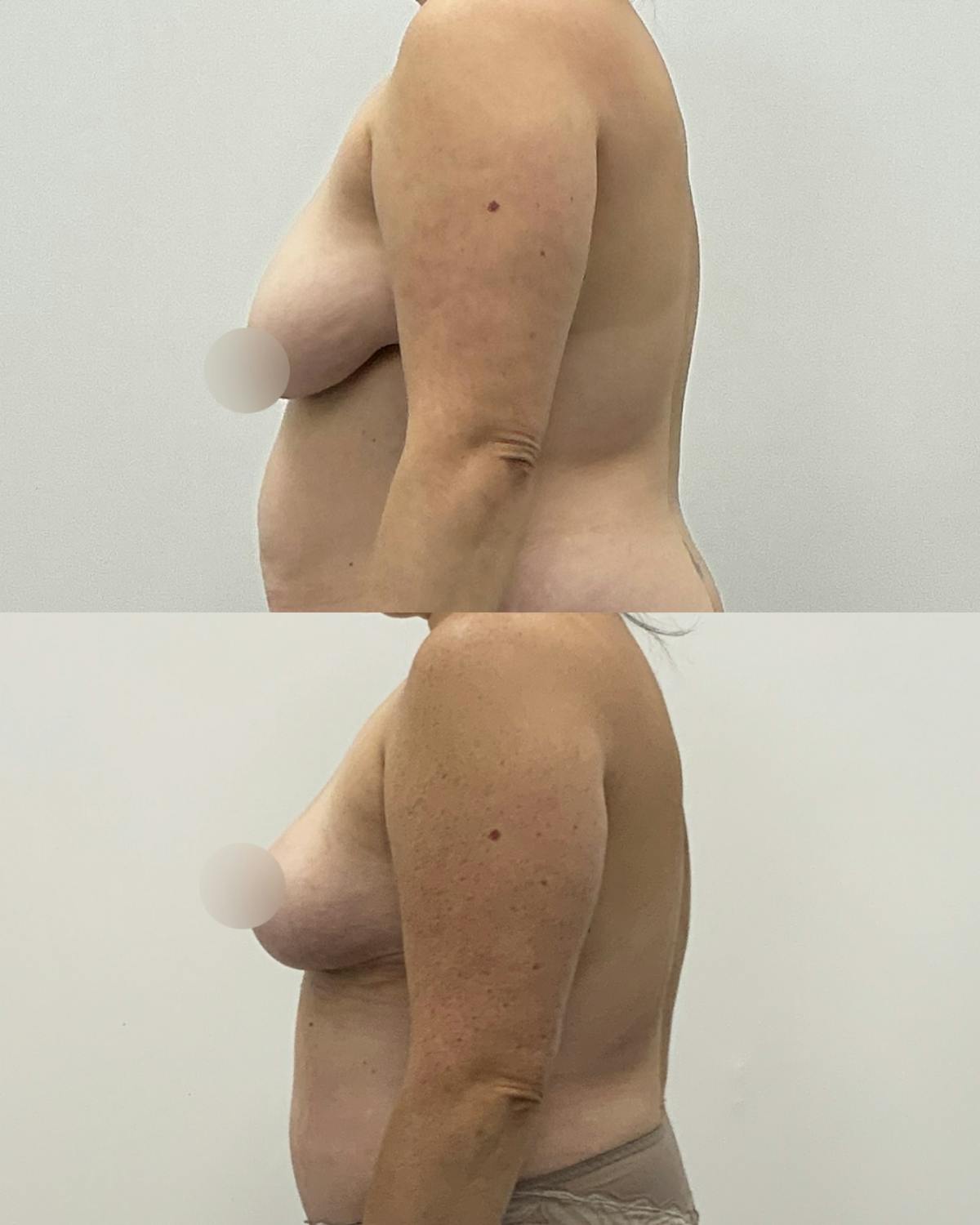 Breast Reduction Before & After Gallery - Patient 110044 - Image 3