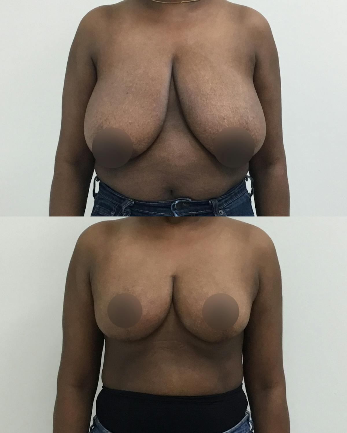 Breast Reduction Before & After Gallery - Patient 231237 - Image 1