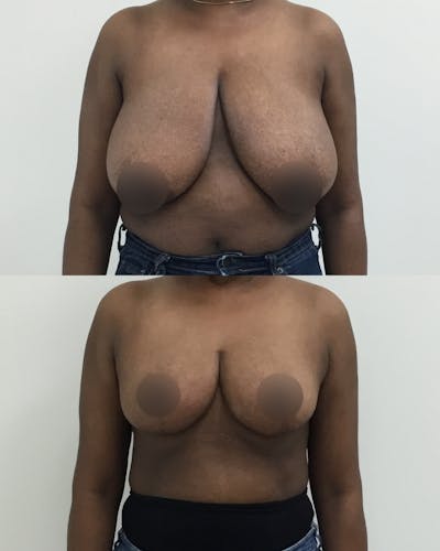 Breast Lift Before & After Gallery - Patient 105288 - Image 1