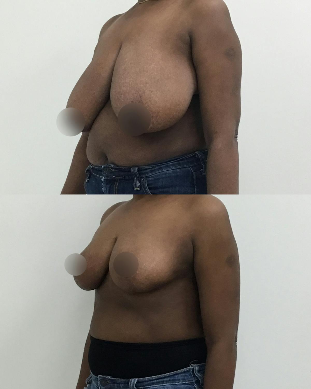 Breast Reduction Before & After Gallery - Patient 231237 - Image 2