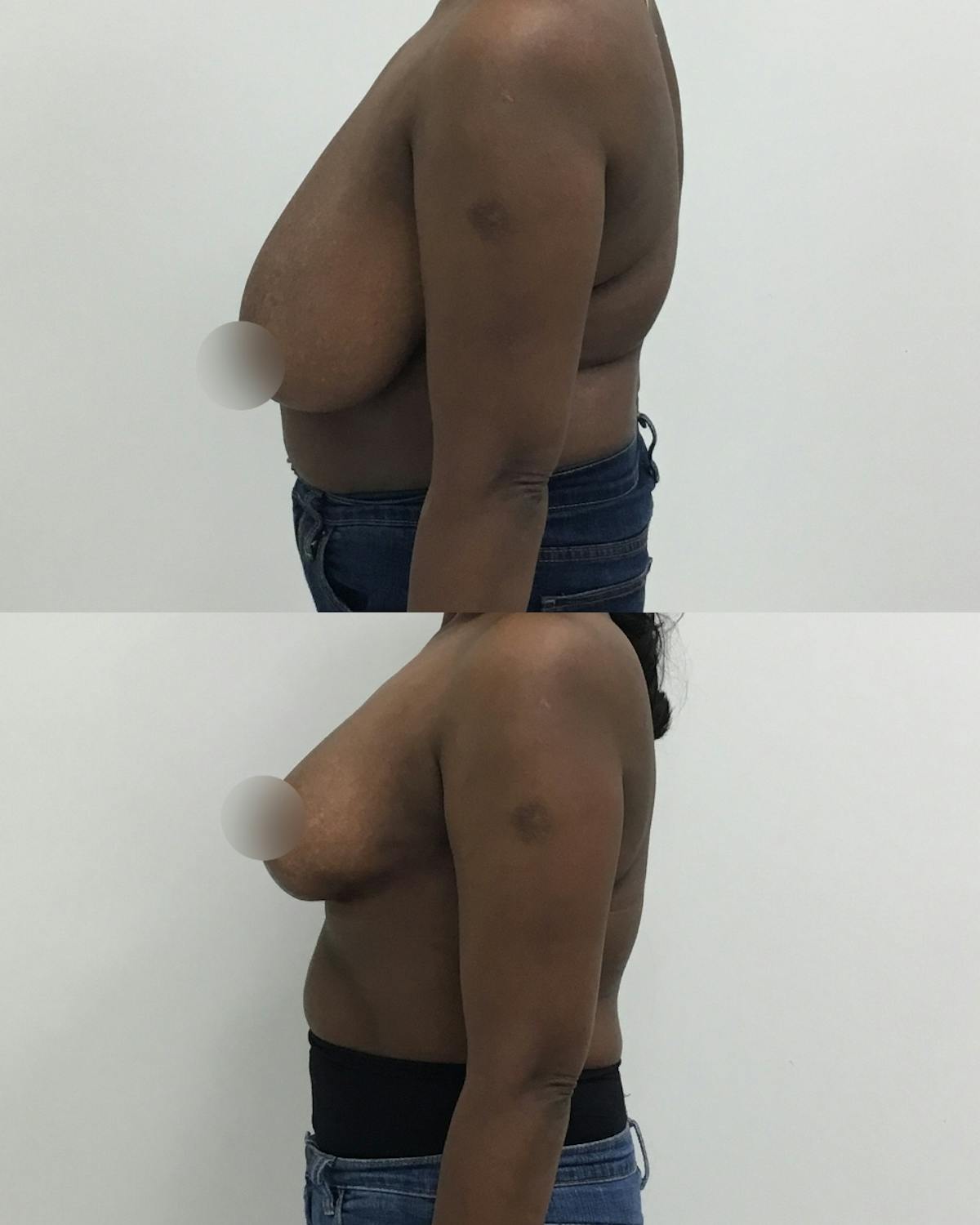 Breast Reduction Before & After Gallery - Patient 231237 - Image 3