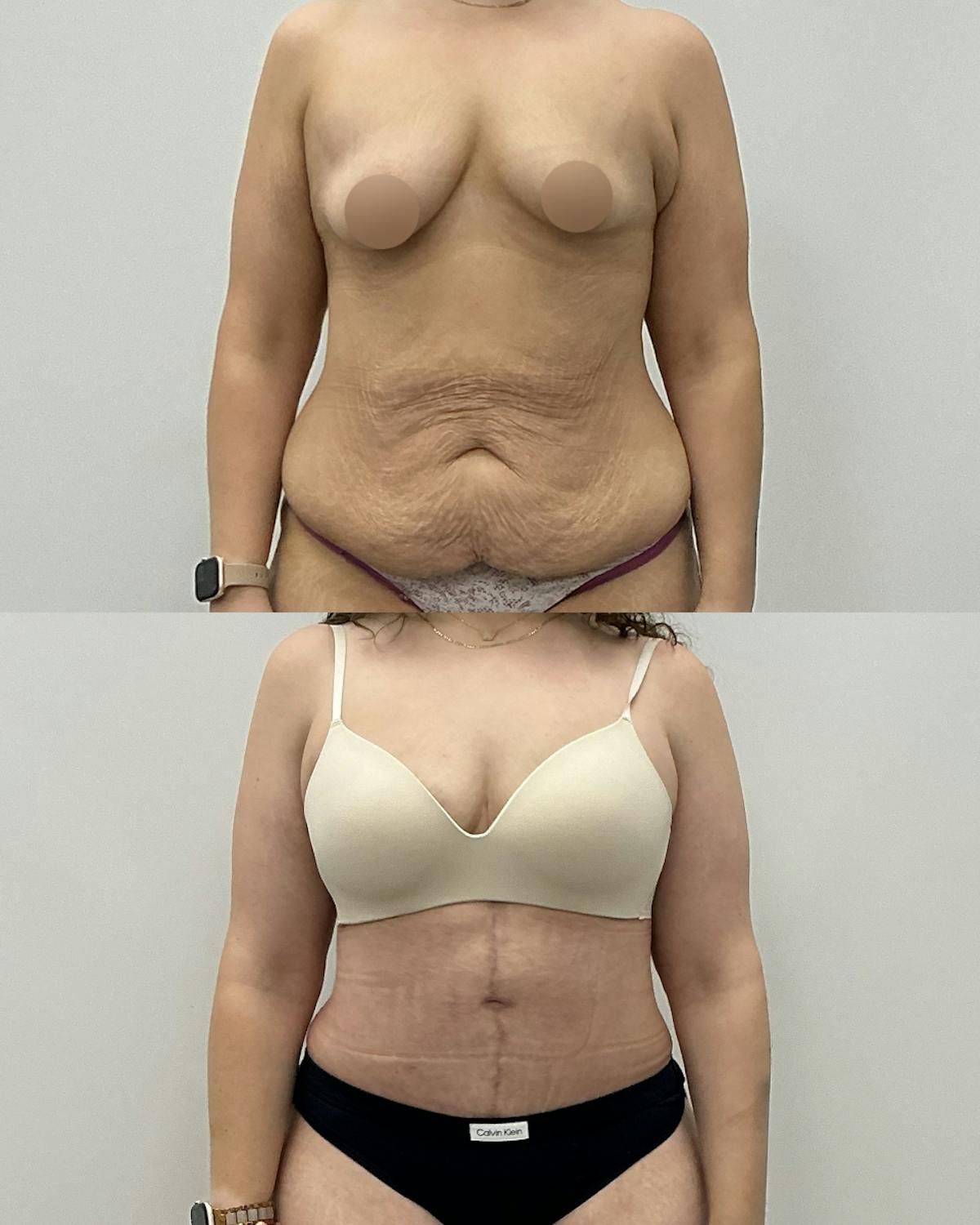 Tummy Tuck Before & After Gallery - Patient 109214 - Image 1