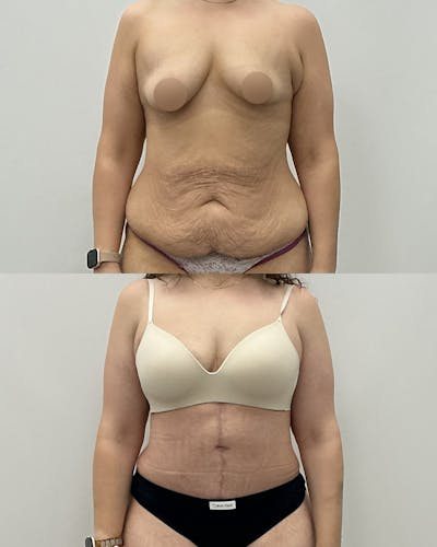 Tummy Tuck Before & After Gallery - Patient 109214 - Image 1