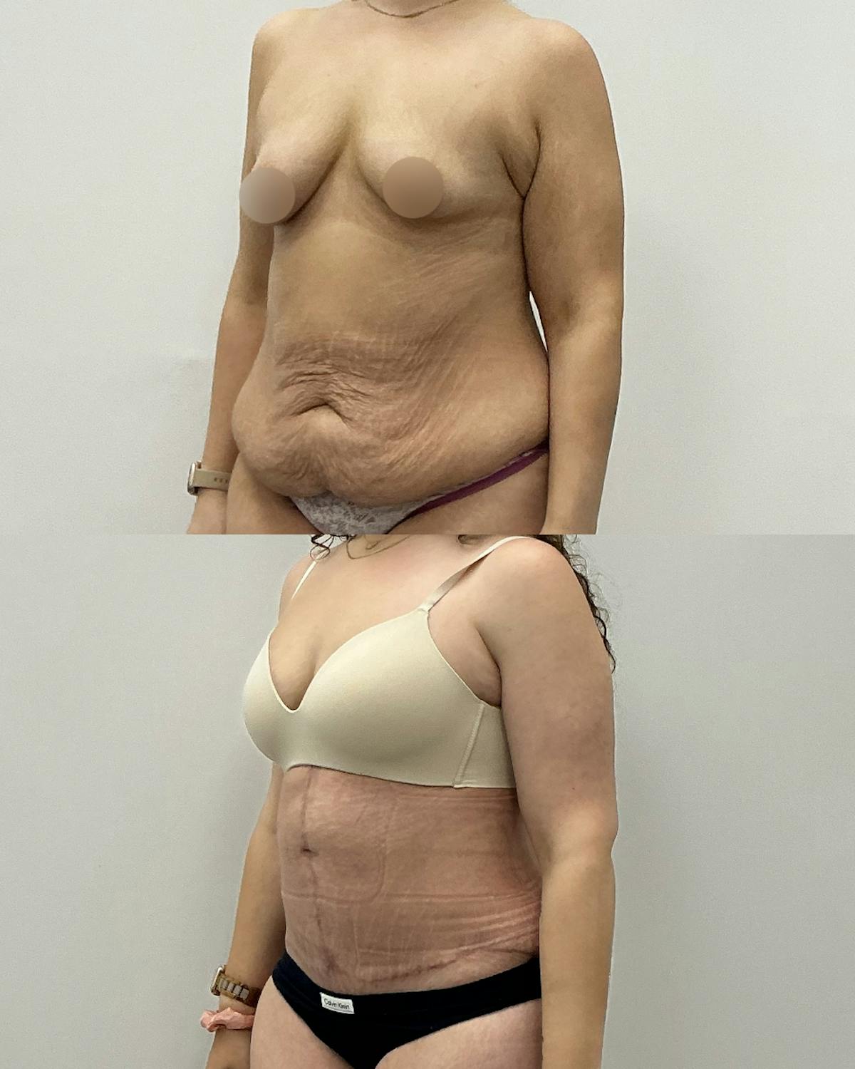 Tummy Tuck Before & After Gallery - Patient 109214 - Image 2