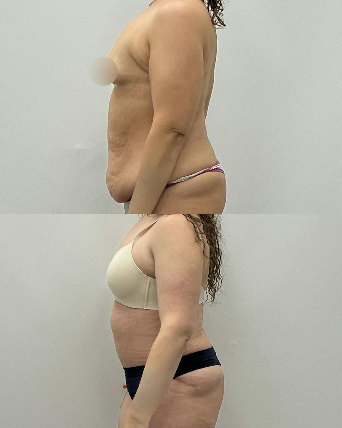 Tummy Tuck Before & After Gallery - Patient 109214 - Image 3