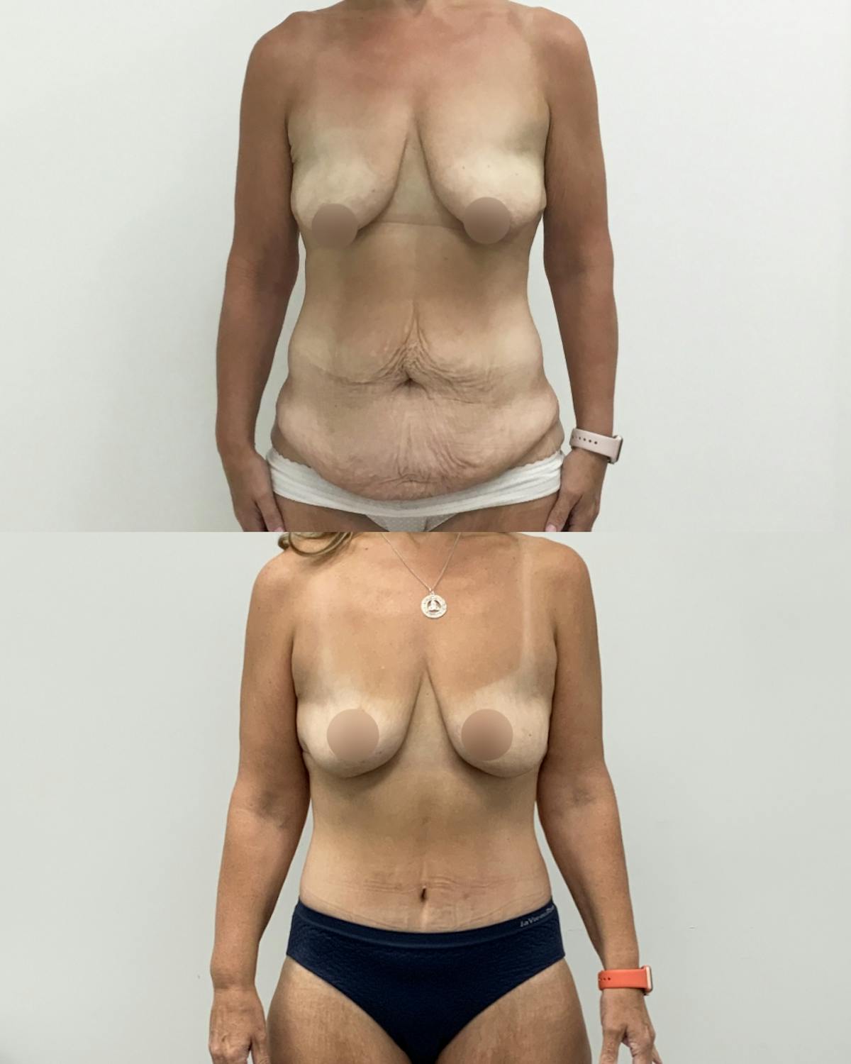 Tummy Tuck Before & After Gallery - Patient 189456 - Image 1