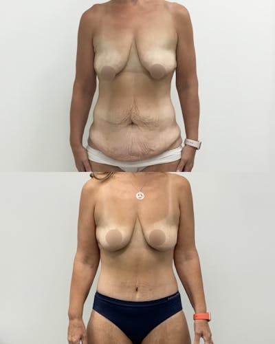 Tummy Tuck Before & After Gallery - Patient 189456 - Image 1