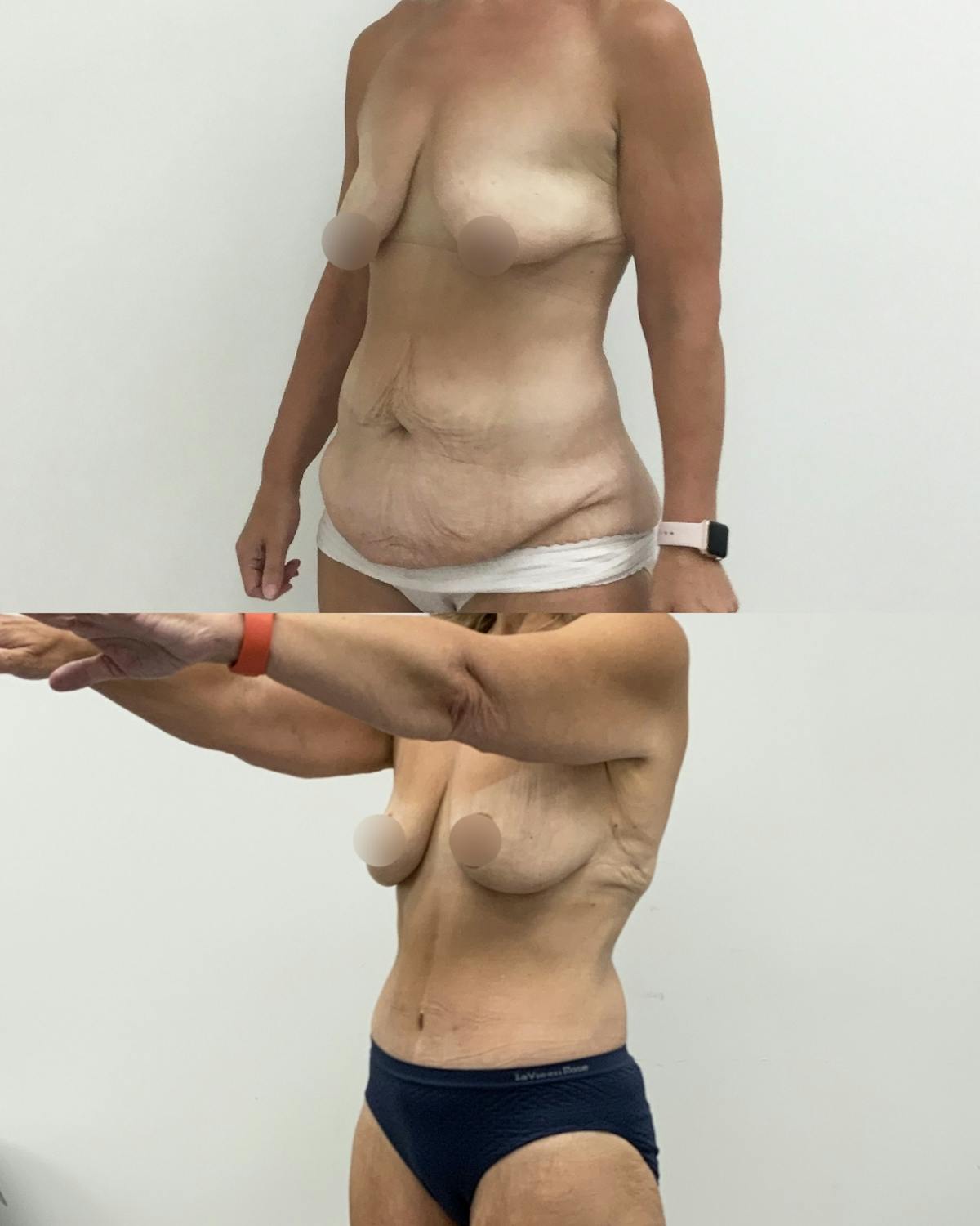 Tummy Tuck Before & After Gallery - Patient 189456 - Image 2