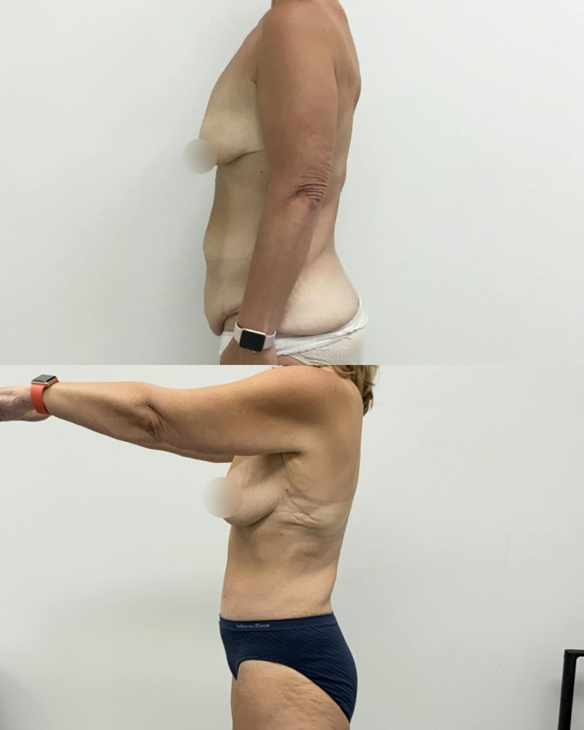 Tummy Tuck Before & After Gallery - Patient 189456 - Image 3