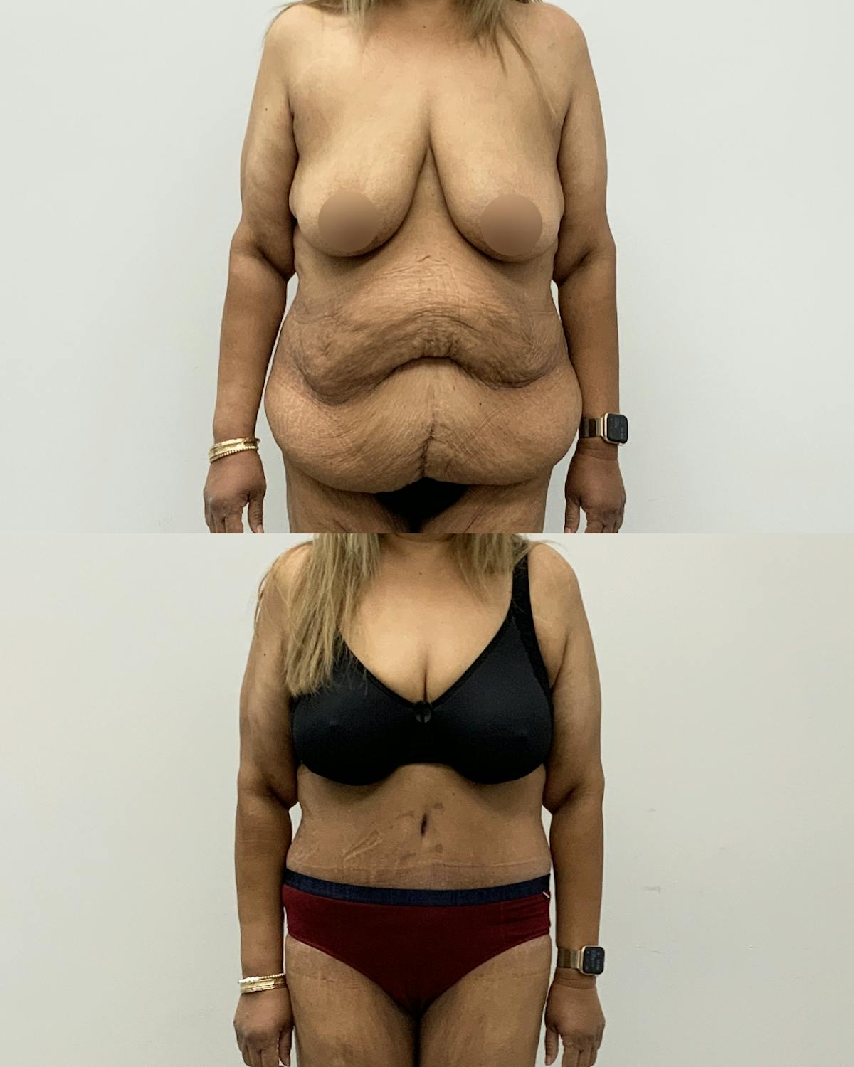 Tummy Tuck Before & After Gallery - Patient 354710 - Image 1
