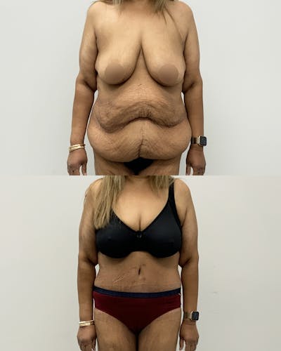 Tummy Tuck Before & After Gallery - Patient 354710 - Image 1