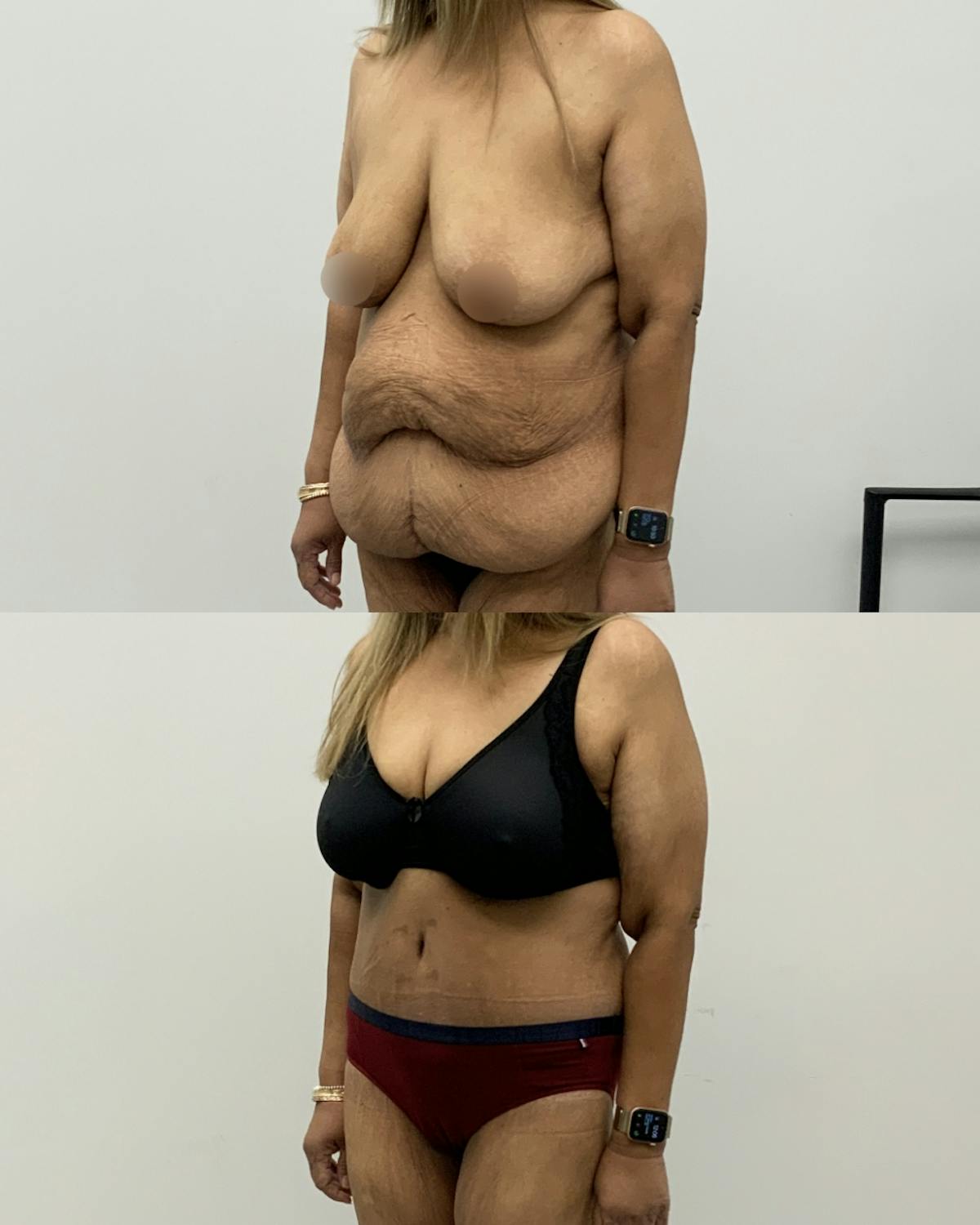 Tummy Tuck Before & After Gallery - Patient 354710 - Image 2