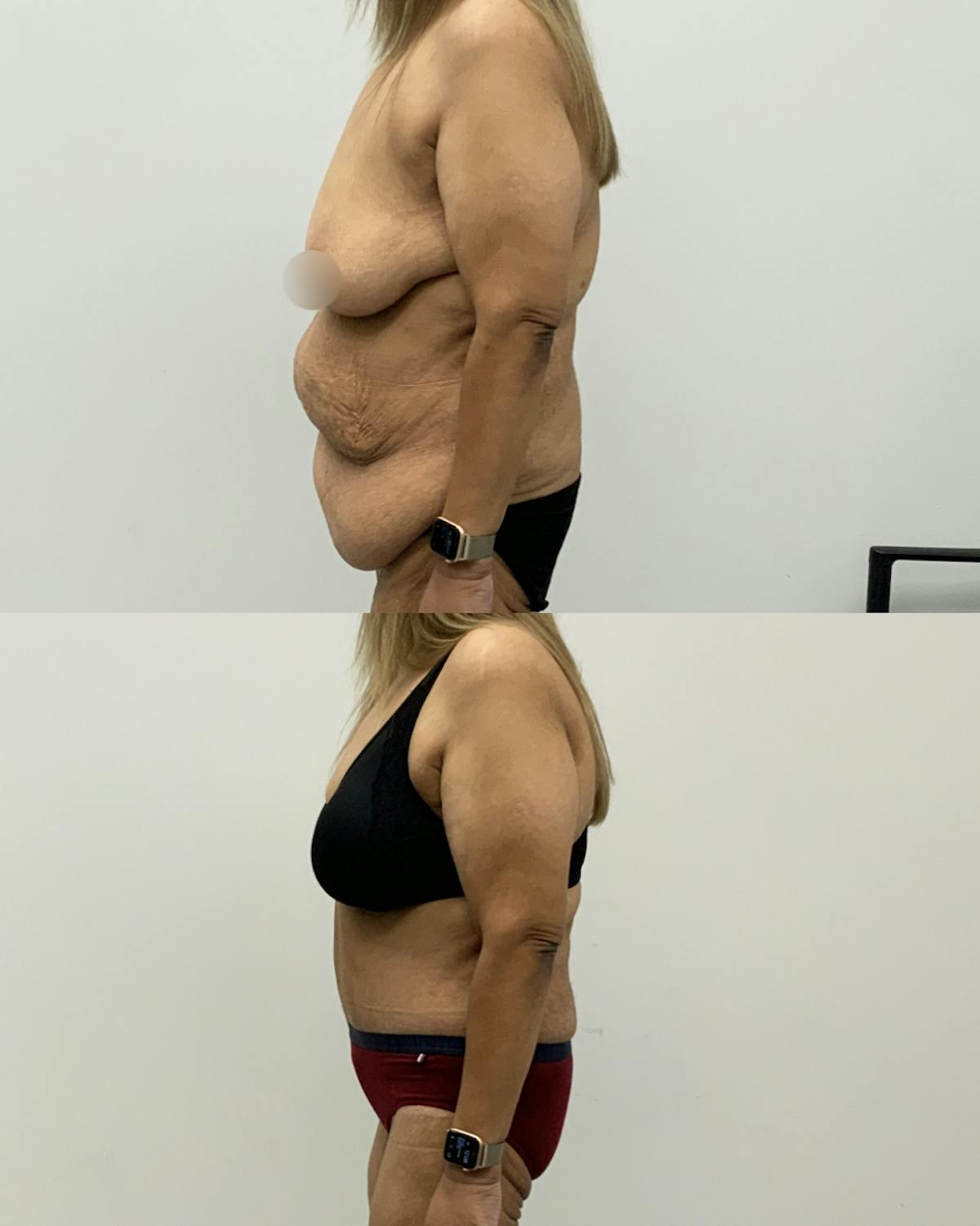 Tummy Tuck Before & After Gallery - Patient 354710 - Image 3