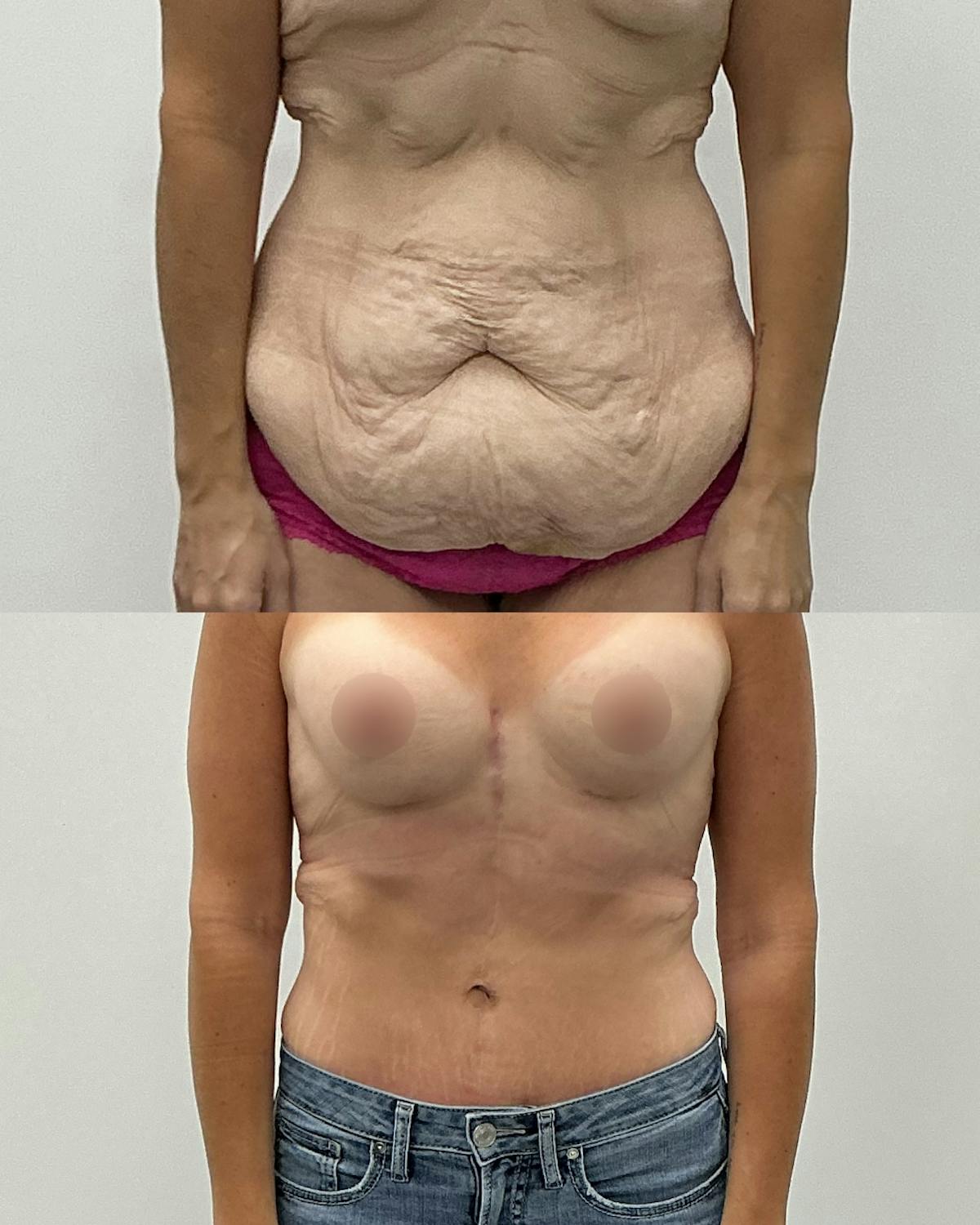 Tummy Tuck Before & After Gallery - Patient 273247 - Image 1