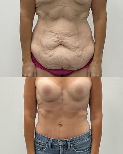 Tummy Tuck Before & After Gallery - Patient 273247 - Image 1