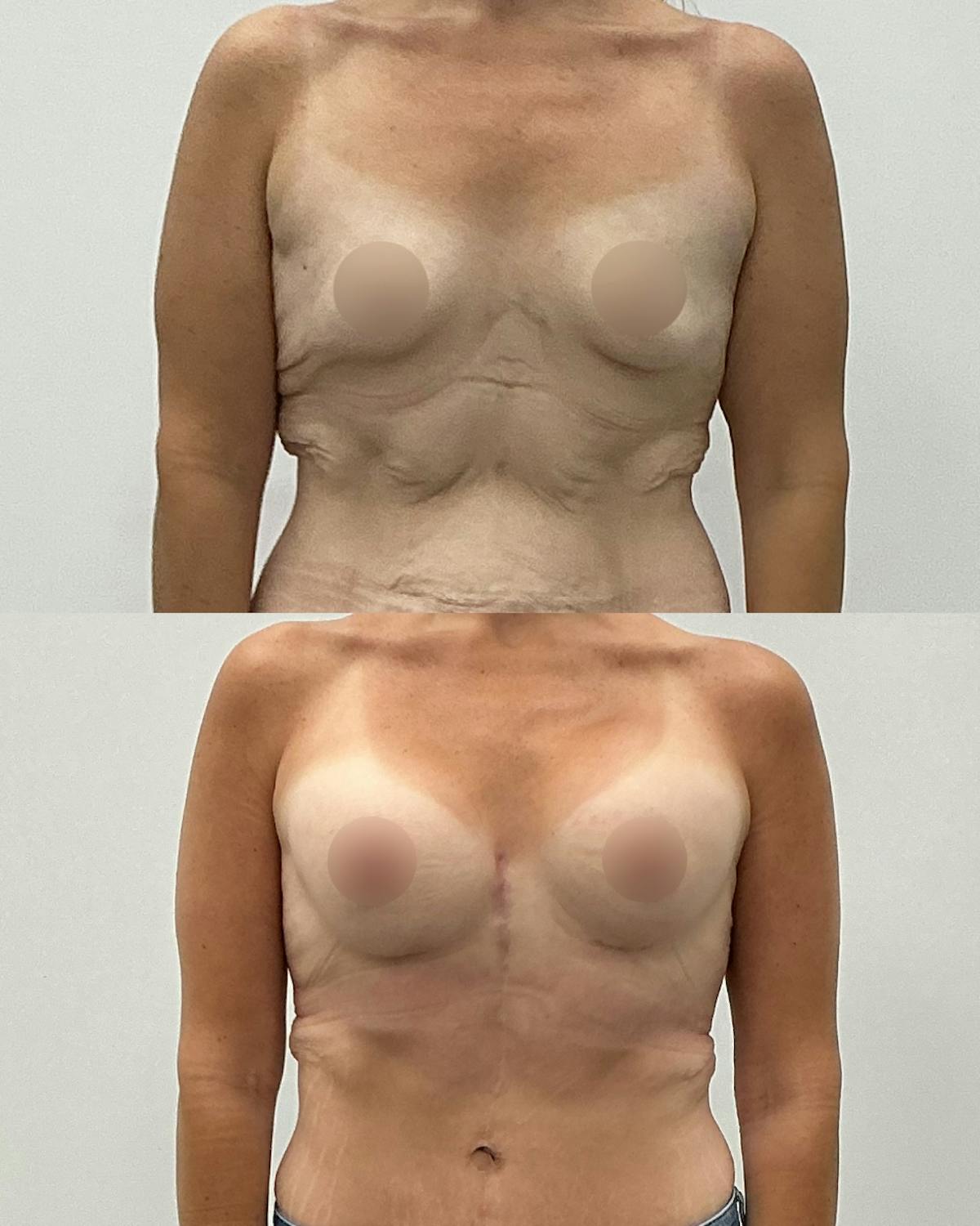 Breast Augmentation Before & After Gallery - Patient 193305 - Image 1