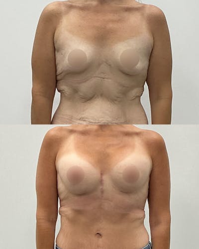 Breast Augmentation Before & After Gallery - Patient 193305 - Image 1