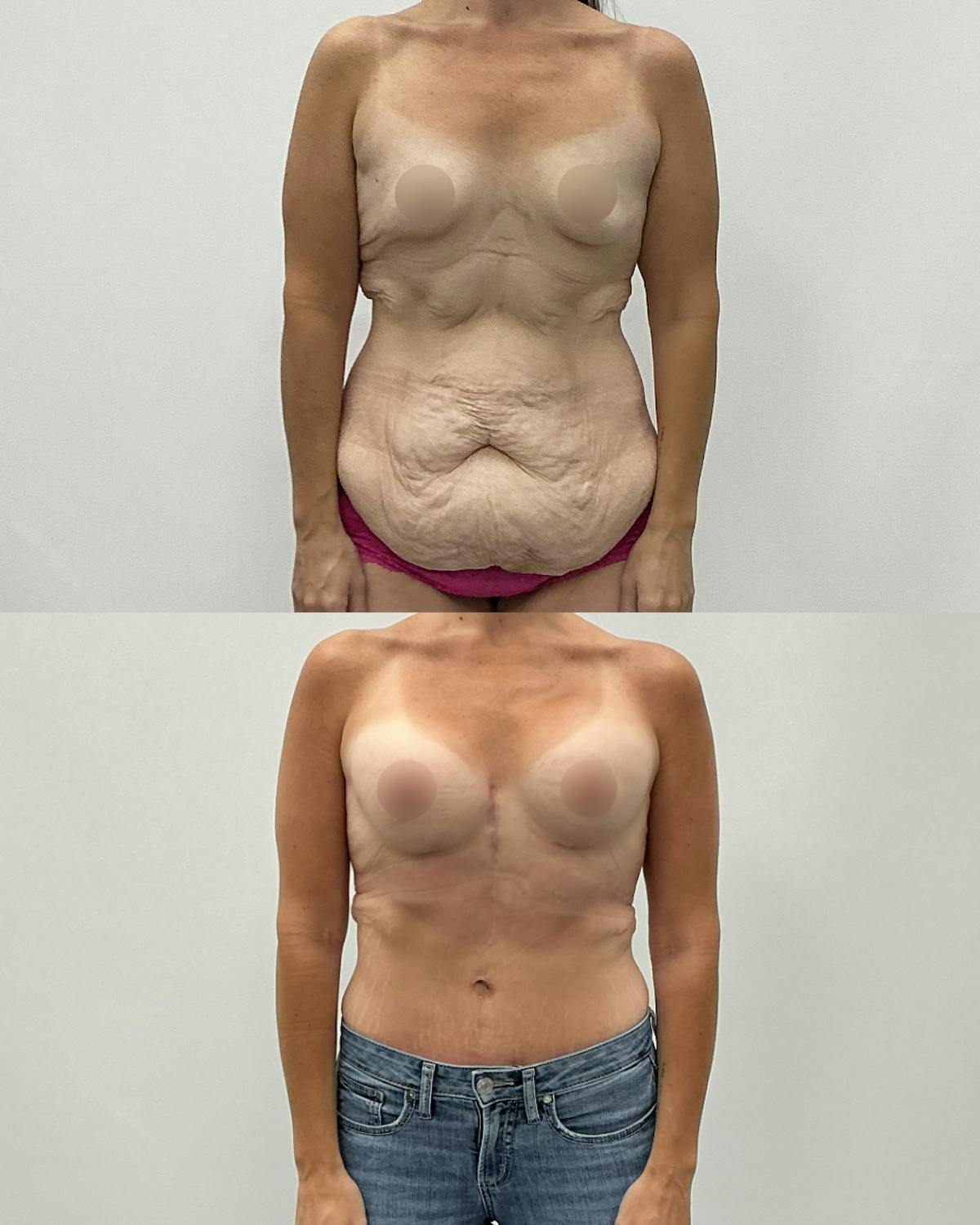 Mommy Makeover Before & After Gallery - Patient 170119 - Image 1