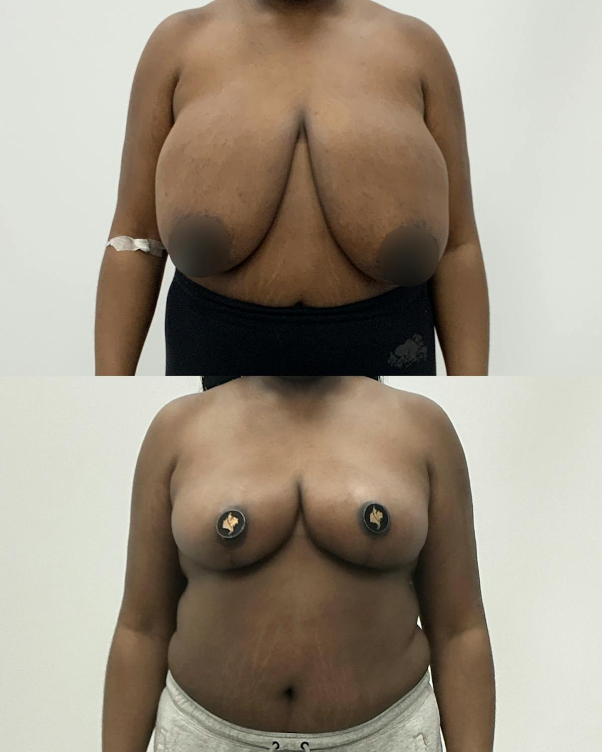 Breast Reduction Before & After Gallery - Patient 259061 - Image 1