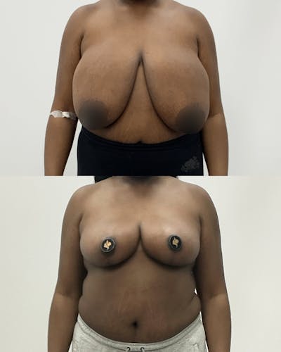 Breast Lift Before & After Gallery - Patient 411348 - Image 1