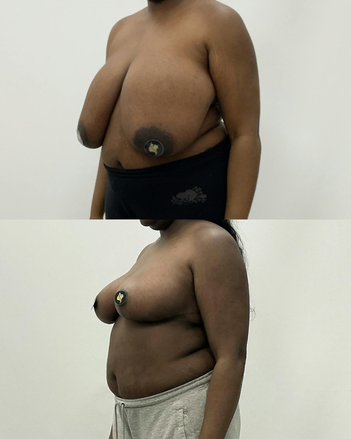 Breast Reduction Before & After Gallery - Patient 259061 - Image 2