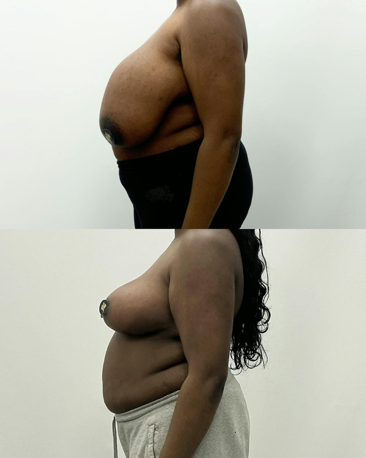 Breast Reduction Before & After Gallery - Patient 259061 - Image 3