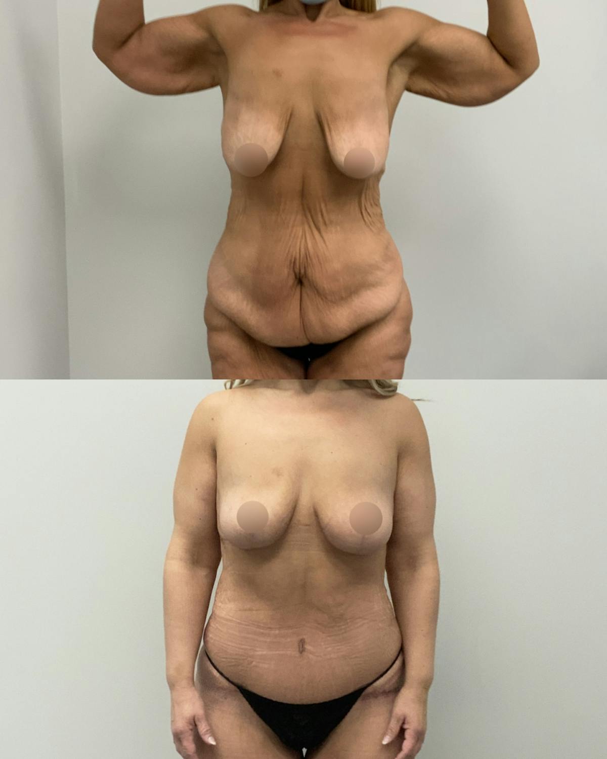 Mommy Makeover Before & After Gallery - Patient 275421 - Image 1