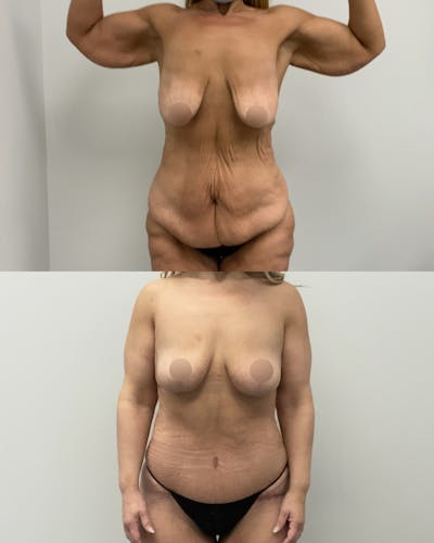 Mommy Makeover Before & After Gallery - Patient 275421 - Image 1