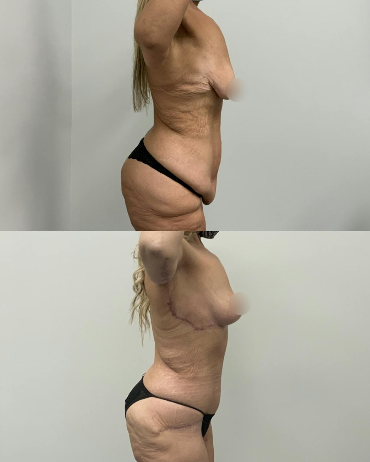 Mommy Makeover Before & After Gallery - Patient 275421 - Image 3