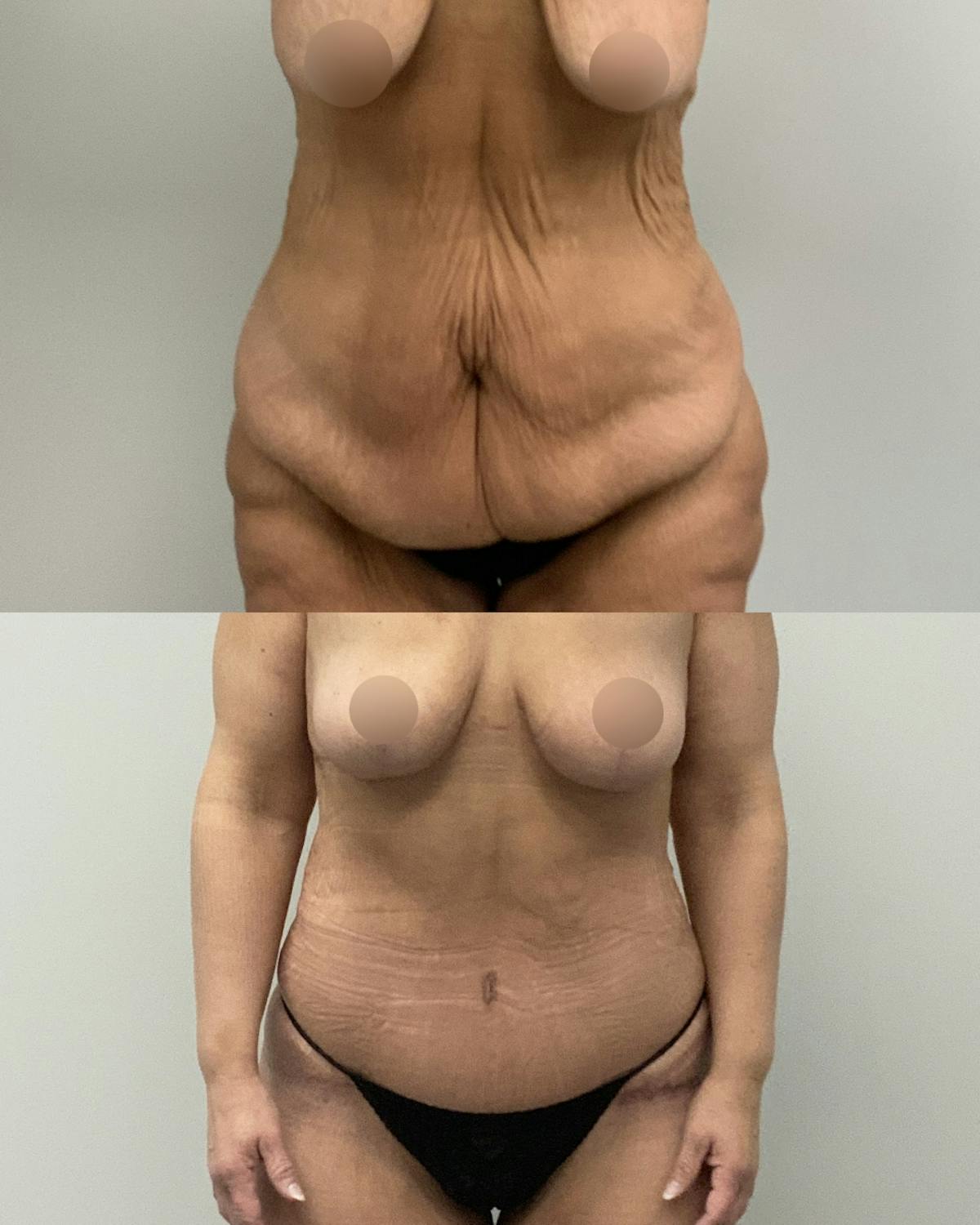 Tummy Tuck Before & After Gallery - Patient 119641 - Image 1