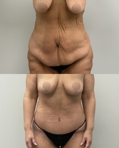 Tummy Tuck Before & After Gallery - Patient 119641 - Image 1