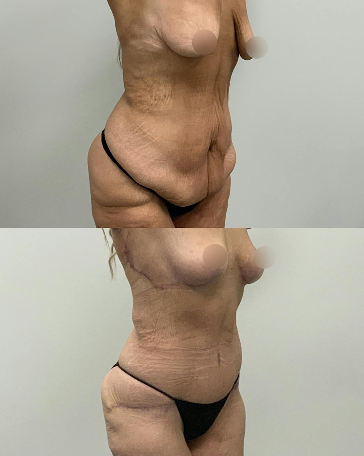 Tummy Tuck Before & After Gallery - Patient 119641 - Image 2