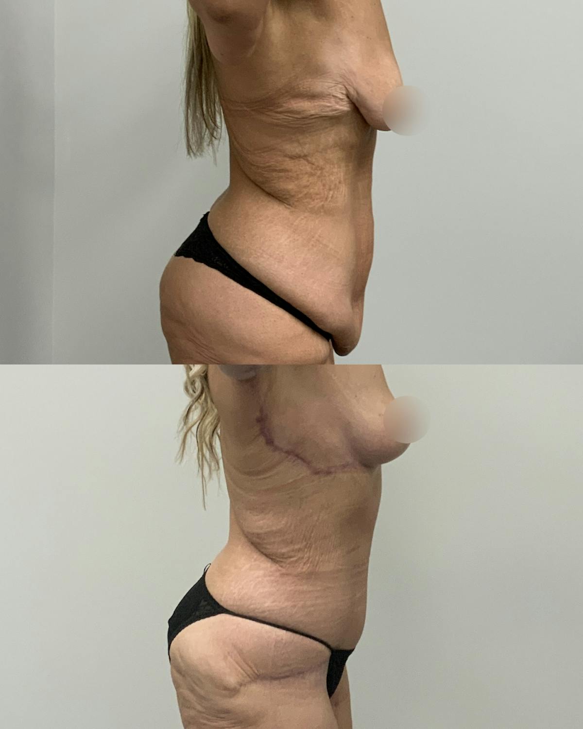 Tummy Tuck Before & After Gallery - Patient 119641 - Image 3