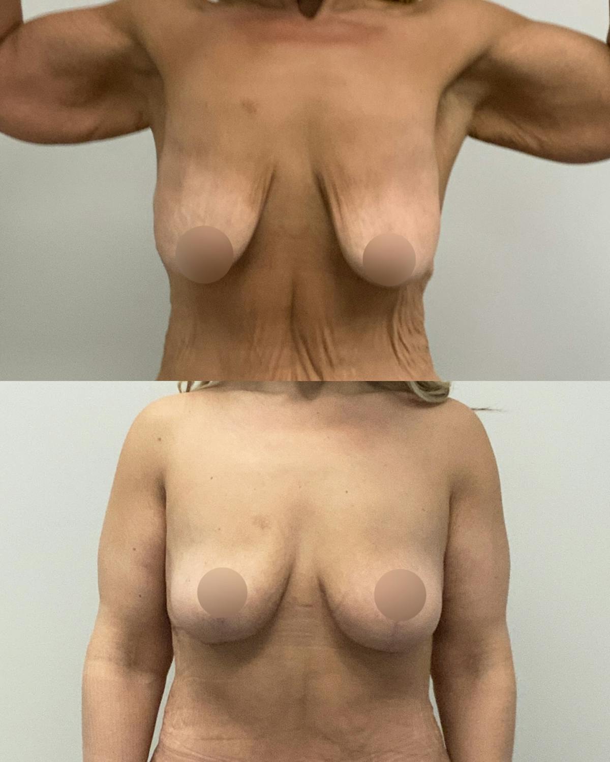 Breast Lift Before & After Gallery - Patient 299135 - Image 1