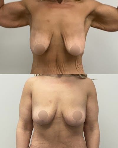 Breast Lift Before & After Gallery - Patient 299135 - Image 1