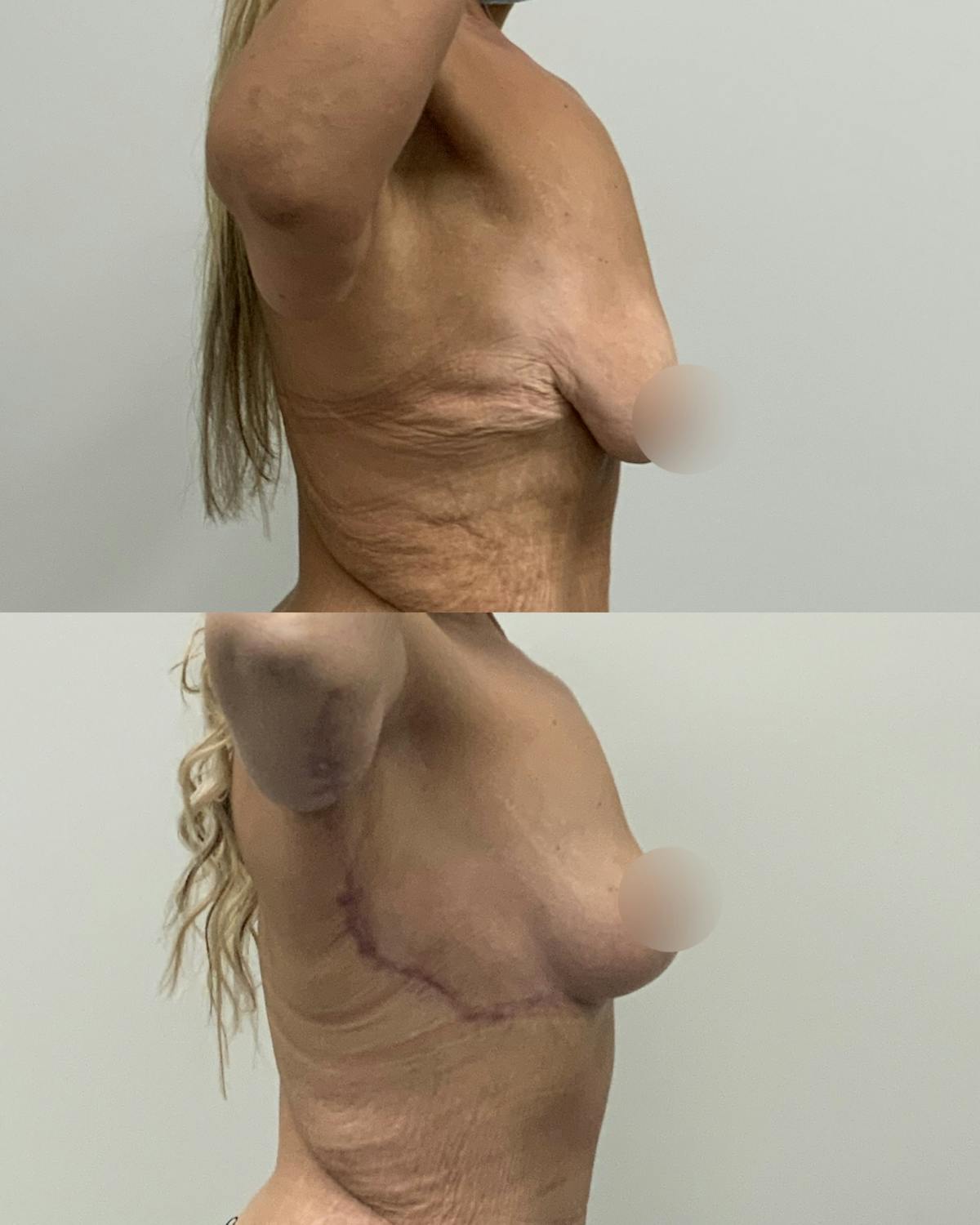 Breast Lift Before & After Gallery - Patient 299135 - Image 3