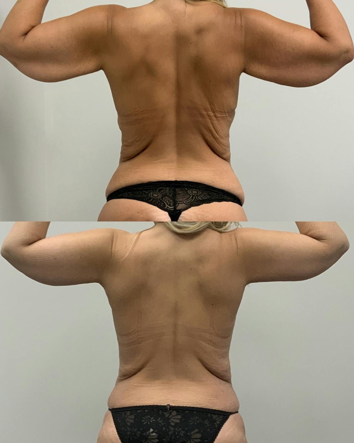 Arm Lift Before & After Gallery - Patient 261217 - Image 1