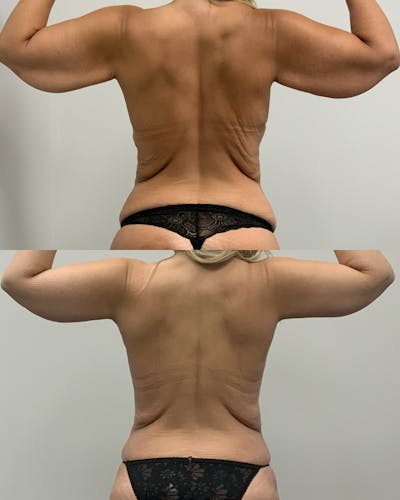 Arm Lift Before & After Gallery - Patient 261217 - Image 1