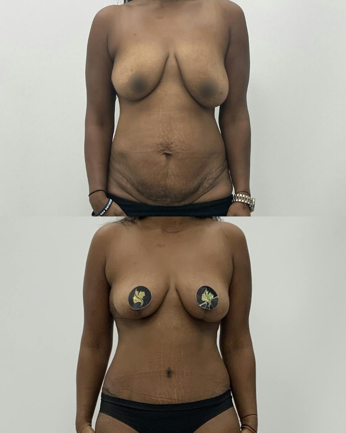Mommy Makeover Before & After Gallery - Patient 992353 - Image 1