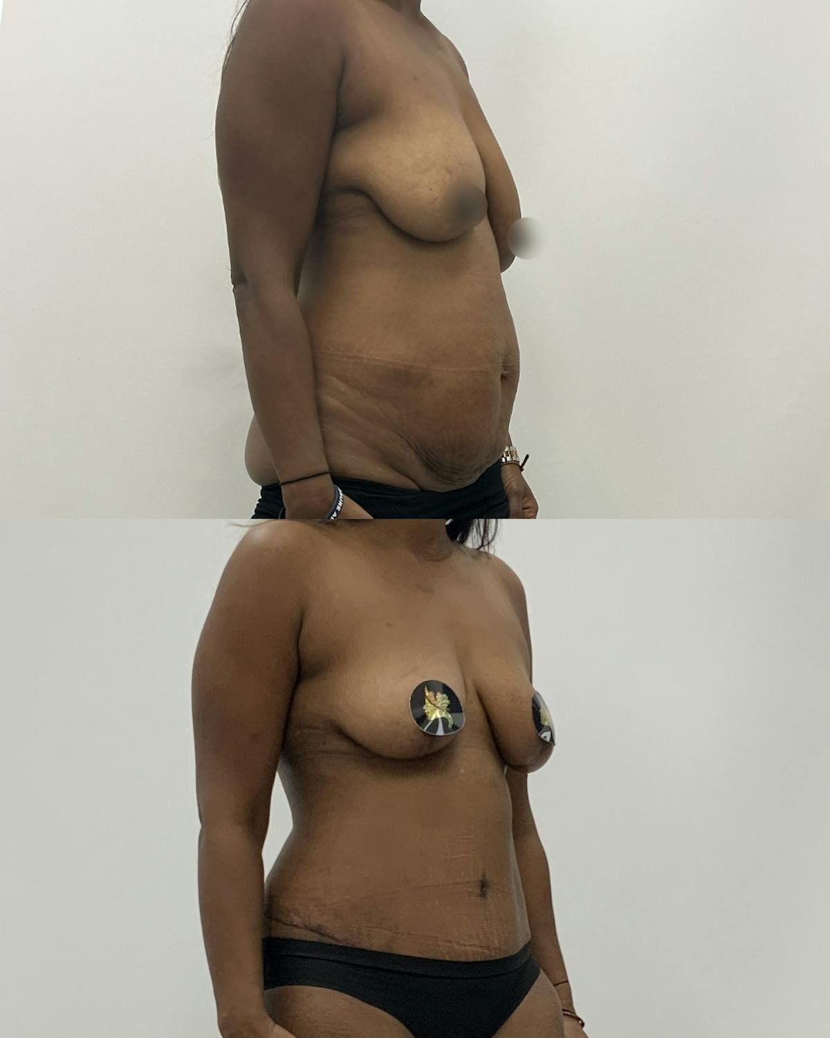 Mommy Makeover Before & After Gallery - Patient 992353 - Image 2